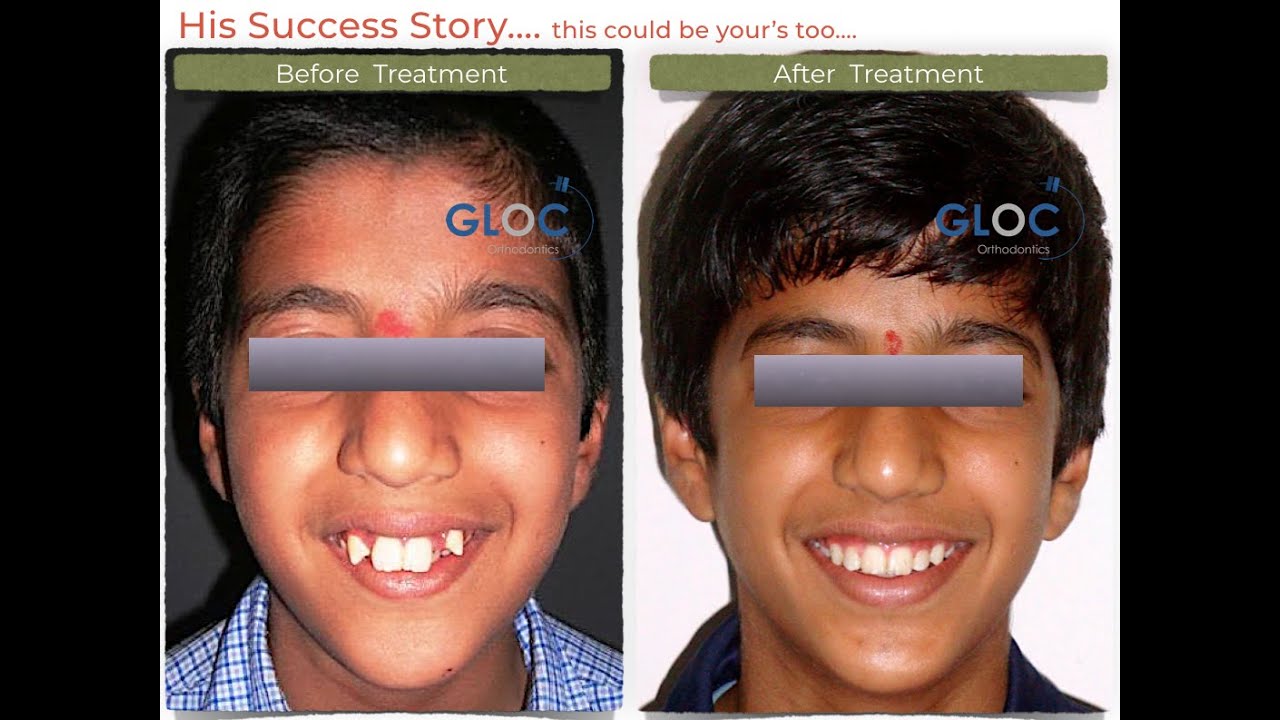 Part 4 Dental Braces Before and After Cosmetic Dental Treatment in