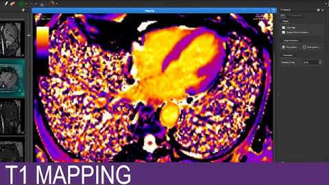 T1 Mapping