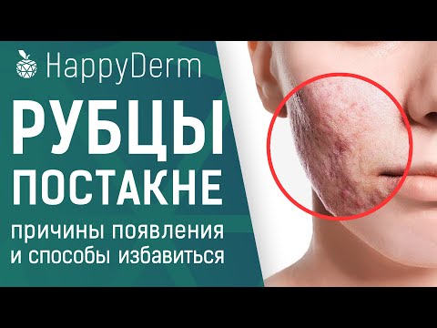 ПОСТАКНЕ. КАК ВЫЛЕЧИТЬ РУБЦЫ НА КОЖЕ. СОВРЕМЕННЫЕ МЕТОДЫ ЛЕЧЕНИЯ РУБЦОВ ПОСТАКНЕ