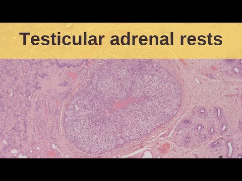Vídeo: Características Ultrassonográficas Da Adrenal Testicular Repousam Tumores Em Pacientes Com Hiperplasia Adrenal Congênita: Experiência Em Um único Centro E Revisão Da Literatura