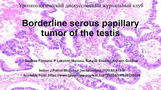 Пограничная серозная папиллярная опухоль яичка (разбор статьи+теория)