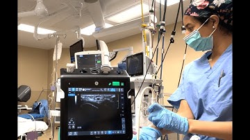 A day in the life of a board certified anesthesiologist assistant- arterial line placement, thoracic