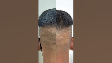 Before and after scalp micropigmentation #scalpmicropigmentation  #smp  #scalpmicropigmentationindia