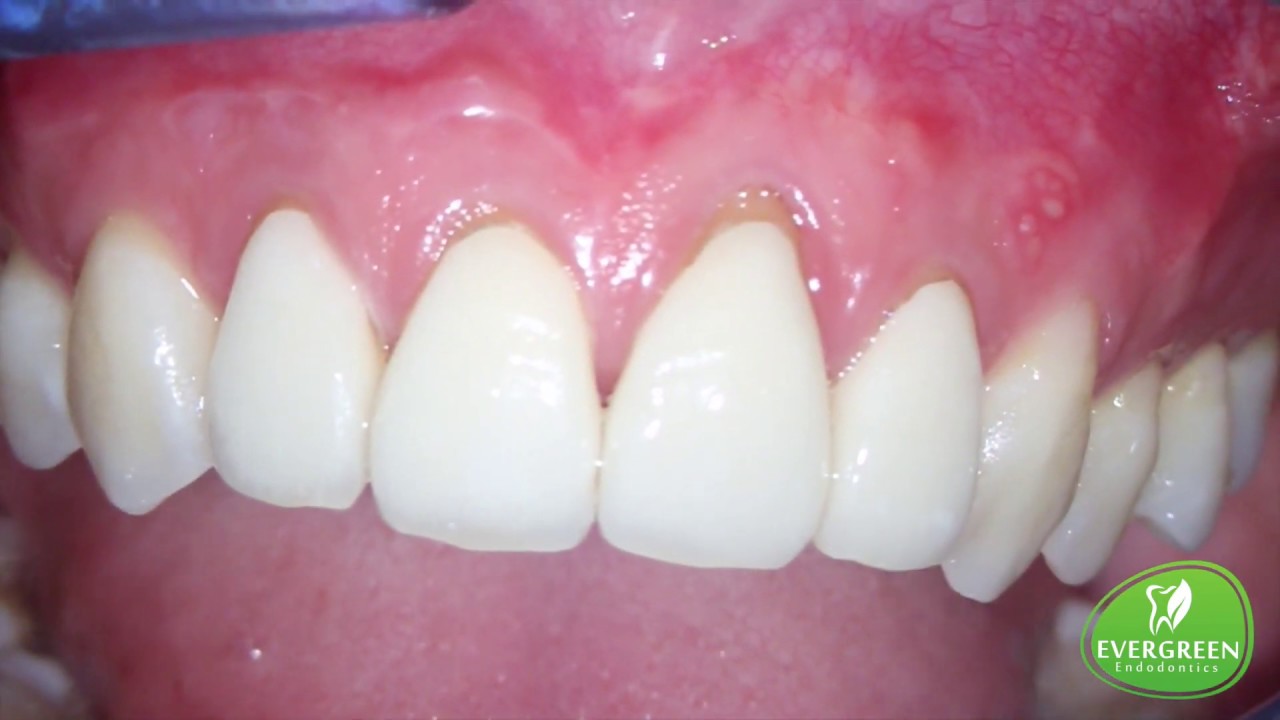 Apicoectomy & Endodontic Microsurgery of Teeth 7 and Tooth 10