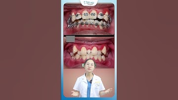 Hành Trình Niềng Răng 18 Tháng Với Tình Trạng Khấp Khểnh Nặng | Nha Khoa Minh Châu