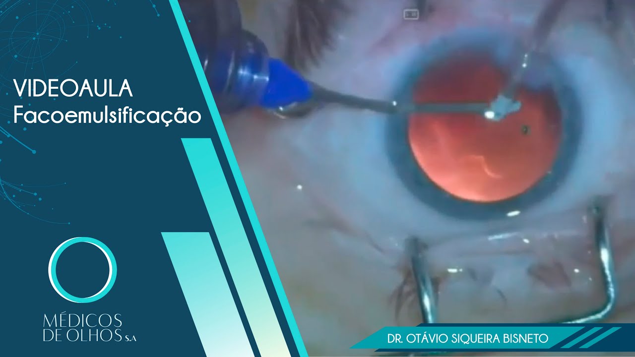 Videoaula Facoemulsificação - YouTube