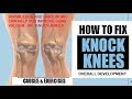 KNOCK KNEES OR GENU VALGUM FOR RUNNERS