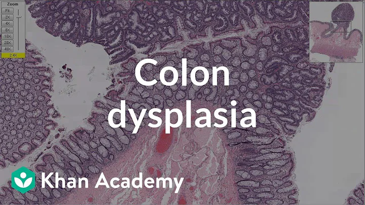 Colon dysplasia | Gastrointestinal system diseases...