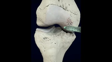 The best treatment for Knee Arthritis