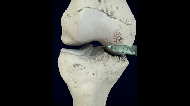The best treatment for Knee Arthritis