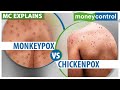 Monkeypox how is it different from chickenpox  explained