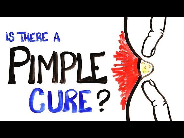 Is There A Pimple Cure?