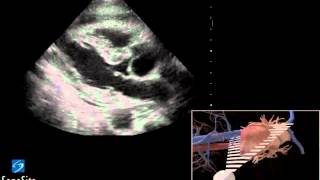 3D How-to: Ultrasound-Guided Paracardiocentesis Procedure - SonoSite Ultrasound