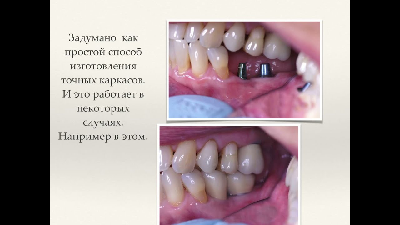 Абатменты 18 видов