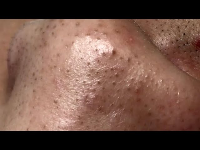 Blackheads..