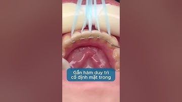 Cách ngăn ngừa răng chạy lại sau khi tháo niềng #shorts