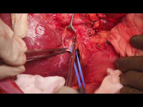 Portal vein dissection for Liver transplant / donor / liver cancer surgery