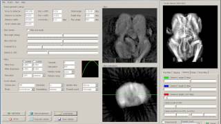 3D x-ray cone beam backprojection Profile