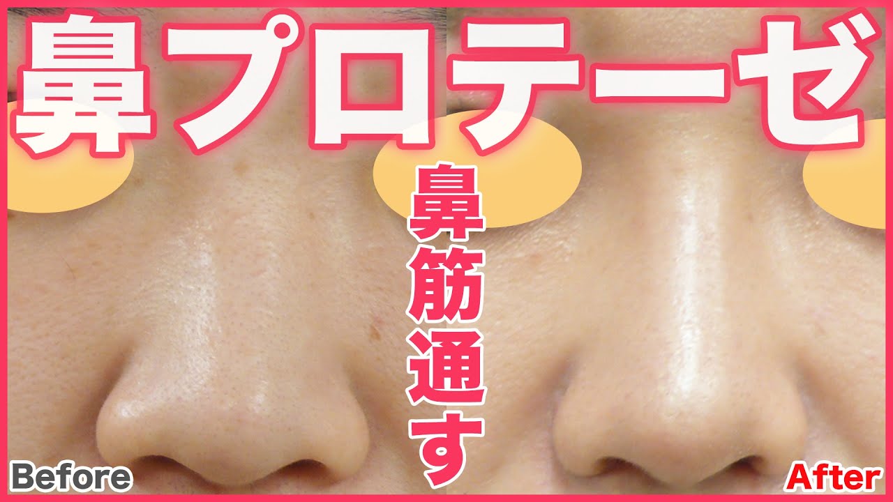 Rhinoplasty] How does a nasal prosthesis change your appearance? A