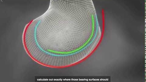 Maintaining the Joint Line in Knee Surgery | Conformis