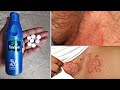 दाद खाज खुजली की 5 दिन में छुट्टी कर देगा | fungal infection treatment at home | dad khaj ka ilaj