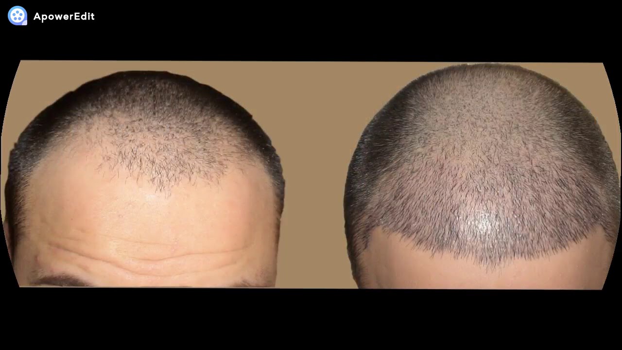 FUE hair transplant in Dubai YouTube