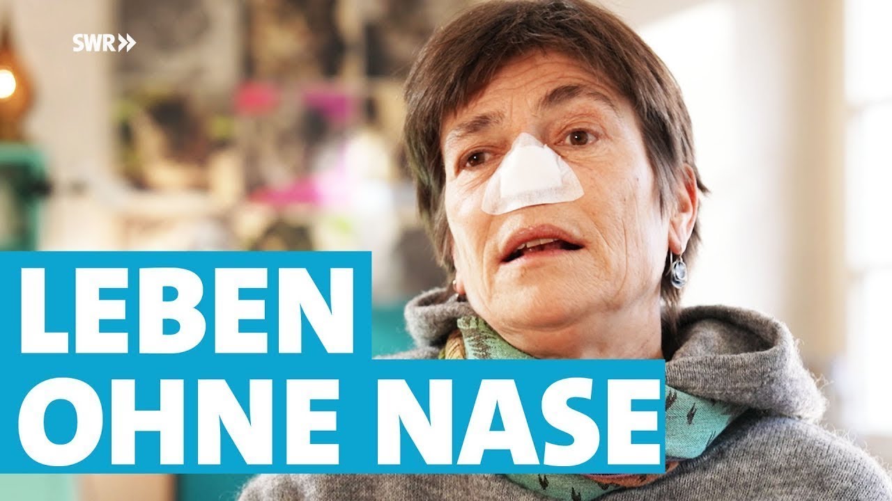 Esther wurde die Nase nach einer Krebserkrankung entfernt