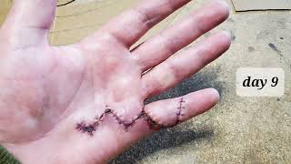 hand surgery healing- time lapse. 36 days in 90 seconds.