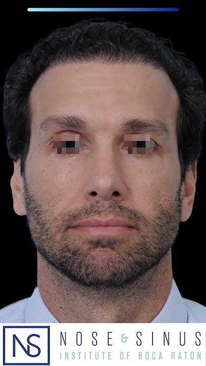 Happy (No) Hump Day! 🤩👃🏻#rhinoplasty