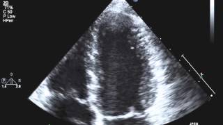 TTE Normal Apical 4 chamber LV zoom Example 1