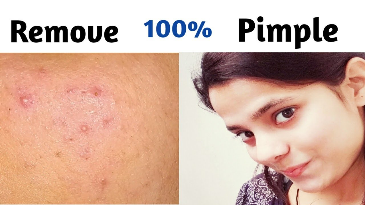 How to remove pimple || remove pimples naturally |Remove pimple | - YouTube