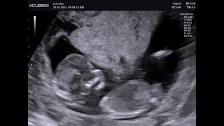 2D Echo 13 Weken Geslachtsbepaling Meisjes
