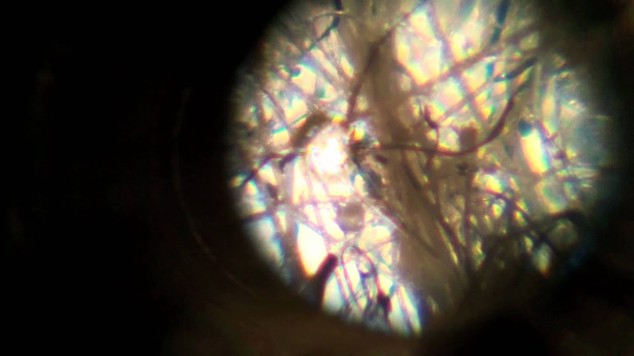 Morgellons Search Results Search Results For Morgellons