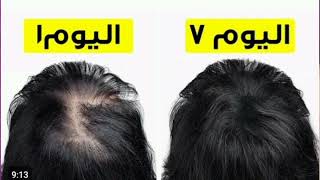 زيوت لتطويل الشعر بسرعة الصاروخmy   Hair care oiling routine