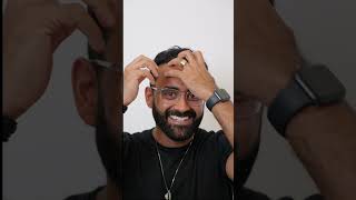 8 Months After Hair Transplant Rishs Incredible Transformation Este Medical Group