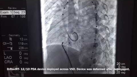DrRaviRT - Large High Muscular VSD Device closure.