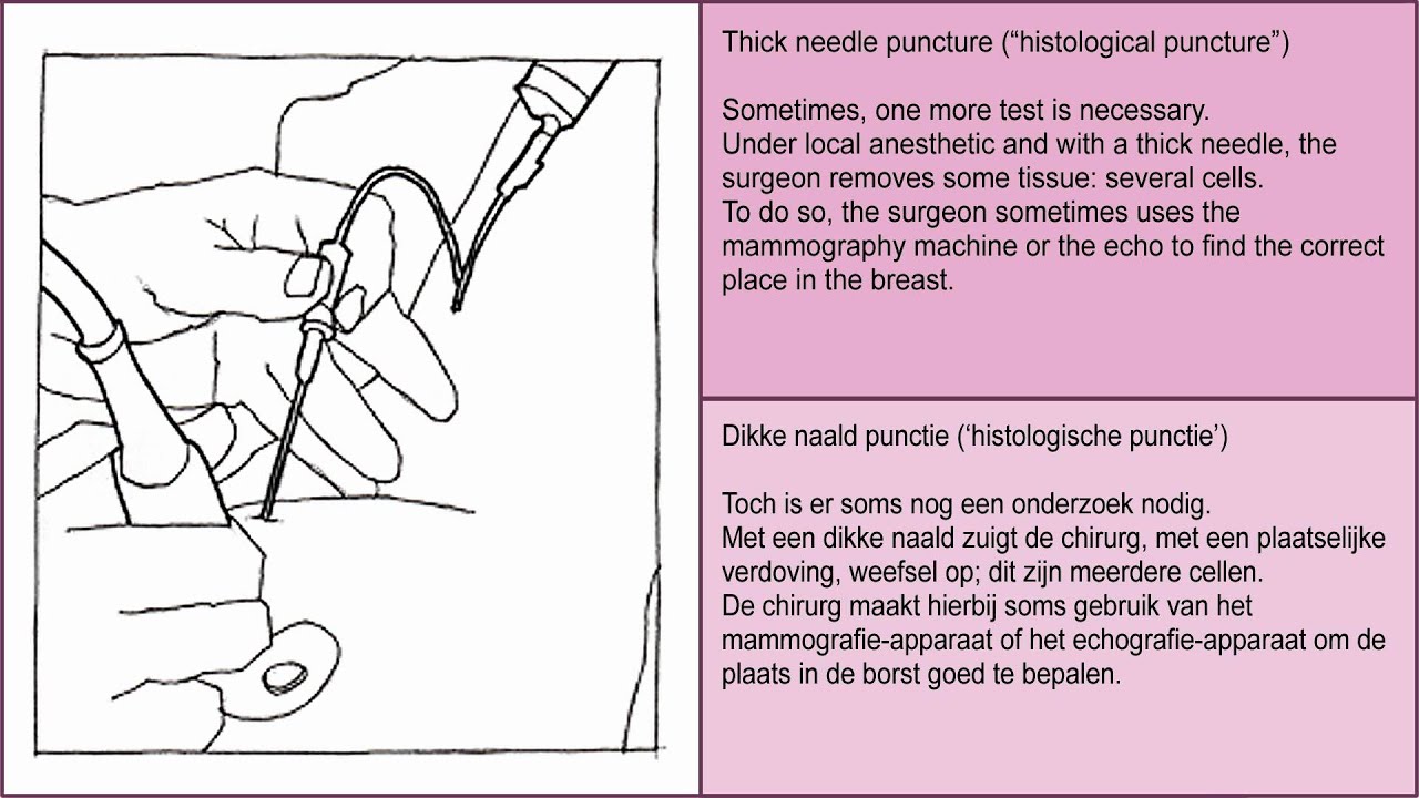 Lumbar Puncture Procedure Note Template