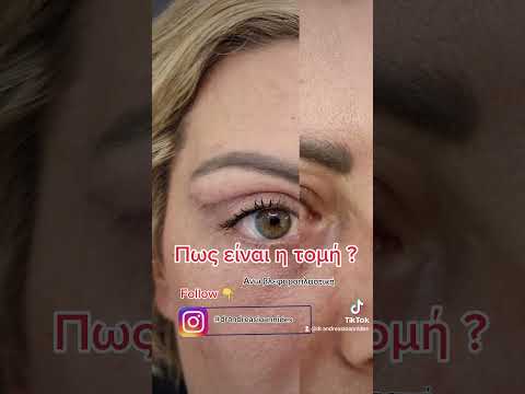 Άνω βλεφαροπλαστική #plasticsurgeon