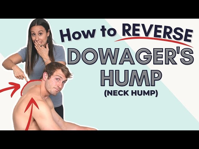 Can Dowager's Hump Be Reversed? - Chiro One