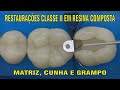 Restauração Classe II em Resina Composta - PARTE 1