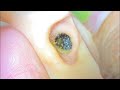 ASMR耳掃除: 黒くて固まった耳垢を全部取り除く!