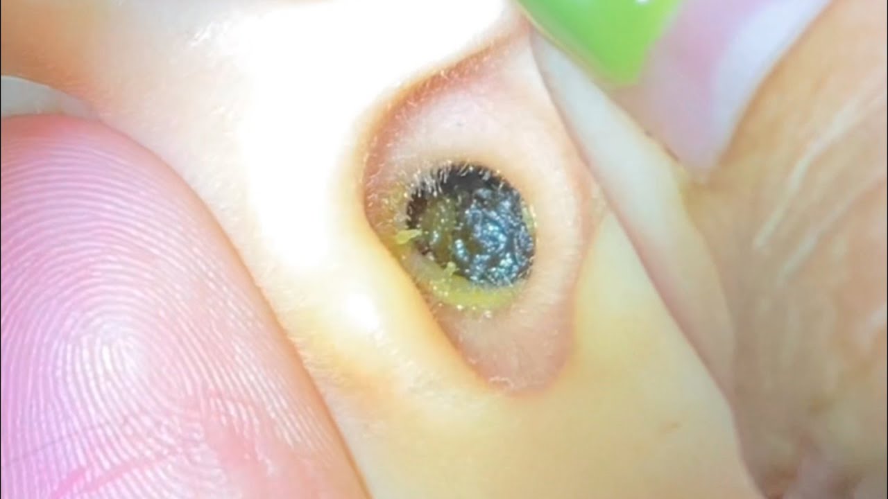 ASMR耳掃除: 黒くて固まった耳垢を全部取り除く!