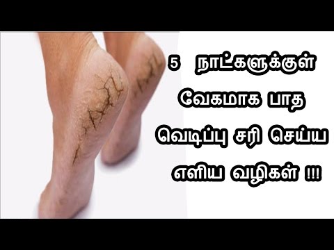 How To Cure Cracked Feet In Tamil - Cracked Heels - Foot Crack - Pedicure Tamil - Tamil Beauty Tips