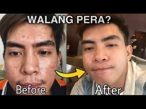 PAANO MAWALA ANG PIMPLES NG WALANG GASTOS in 1 Day | 6 SOLUSYON Paano Maiiwasan ang Pimples