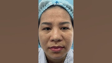 Combo MẮT MŨI #xuhuong #bacsy #lamdep #phauthuatthammy #drkang #drtranbaokhanh #lamdepphaiquyetliet