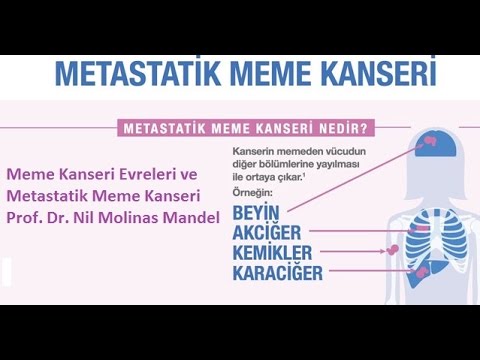Metastatik Meme Kanseri Nedir Ve Meme Kanseri Evreleri Prof Dr Nil Molinas Mandel