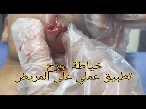 طريقة خياطة الجروح من الالف الى الياء