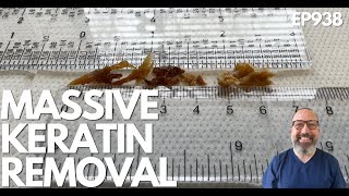 6.5CM/2.5INCHES OF KERATIN REMOVED FROM A PATIENTS EARS - EP938