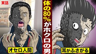 【実話】体の80%がホクロの...オセロ人間。ホクロで耳がふさがる。