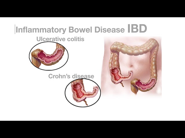 Mayo Clinic Minute: Can diet help with inflammatory bowel disease? - YouTube